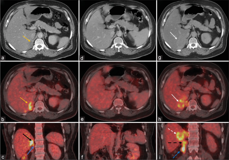 Exploring the Utility of FDG PET-CT in Metastatic Recurrent Extra Skeletal Renal Osteosarcoma.