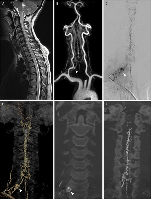 Current Insights and Management Strategies for Lower Cervical Arteriovenous Fistulas: A Comprehensive Review.