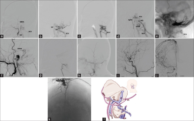 Posterior condylar canal dural arteriovenous fistulas.