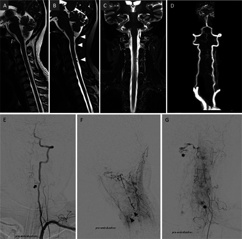 Current Insights and Management Strategies for Lower Cervical Arteriovenous Fistulas: A Comprehensive Review.