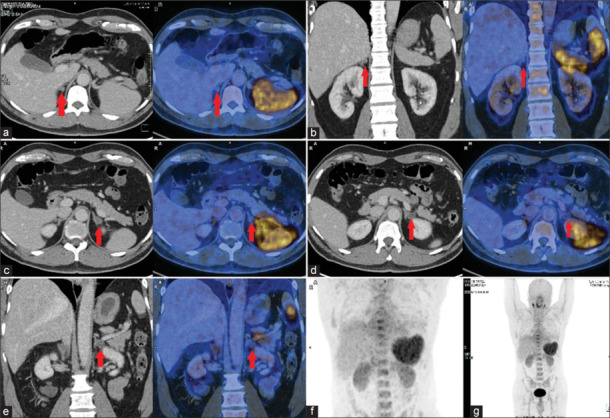 Gallium-68-Pentixafor PET/CT for Subtyping Diagnosis of Primary Aldosteronism: A Pictorial Essay.