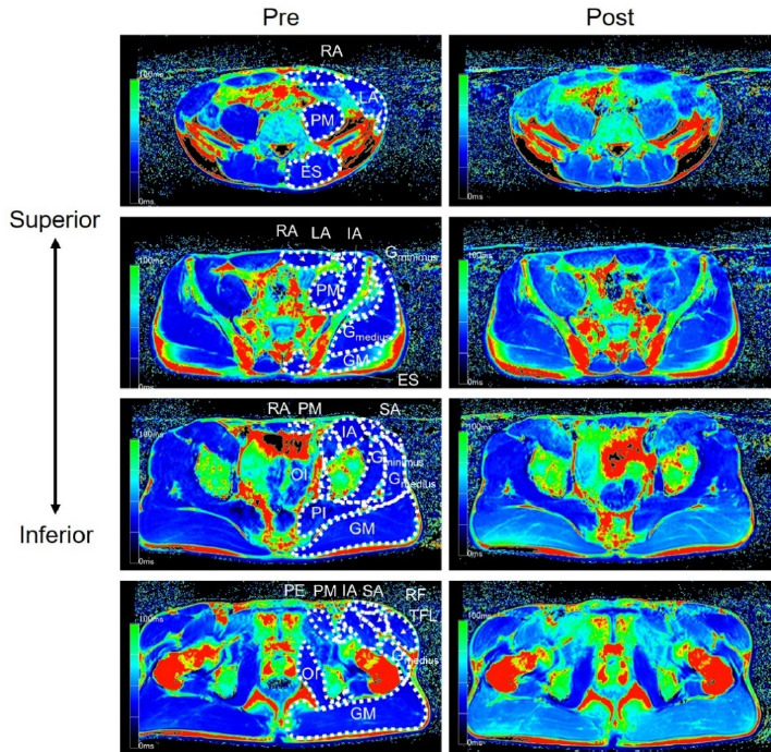 Investigation of Trunk and Pelvis Muscle Activity during Sprinting using T2-Weighted Magnetic Resonance Imaging.