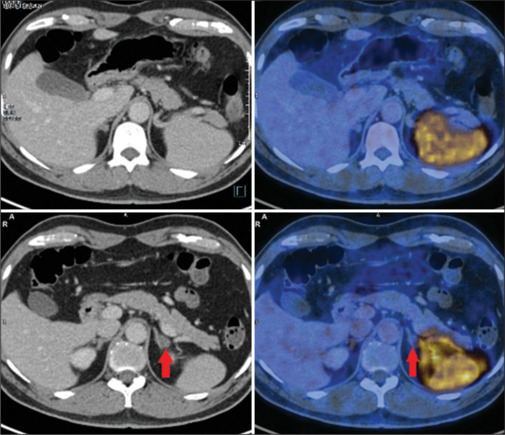 Gallium-68-Pentixafor PET/CT for Subtyping Diagnosis of Primary Aldosteronism: A Pictorial Essay.