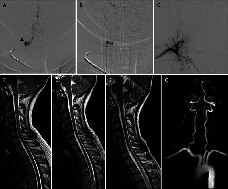 Current Insights and Management Strategies for Lower Cervical Arteriovenous Fistulas: A Comprehensive Review.