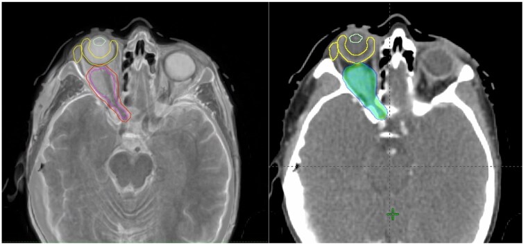 HyperArc radiotherapy for unresectable benign orbital tumours-cohort study and dosimetric comparison study.