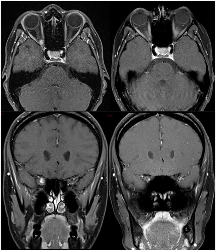 HyperArc radiotherapy for unresectable benign orbital tumours-cohort study and dosimetric comparison study.