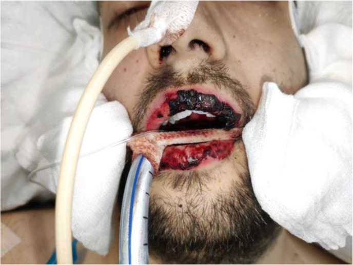 <i>Mycoplasma pneumoniae</i>-Induced Mucositis Sine Rash: <i>Case report in an adult patient</i>.