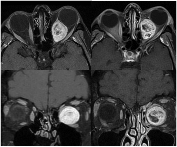 HyperArc radiotherapy for unresectable benign orbital tumours-cohort study and dosimetric comparison study.