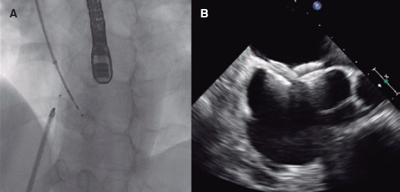 Transcatheter closure of multiperforated atrial septal defect.