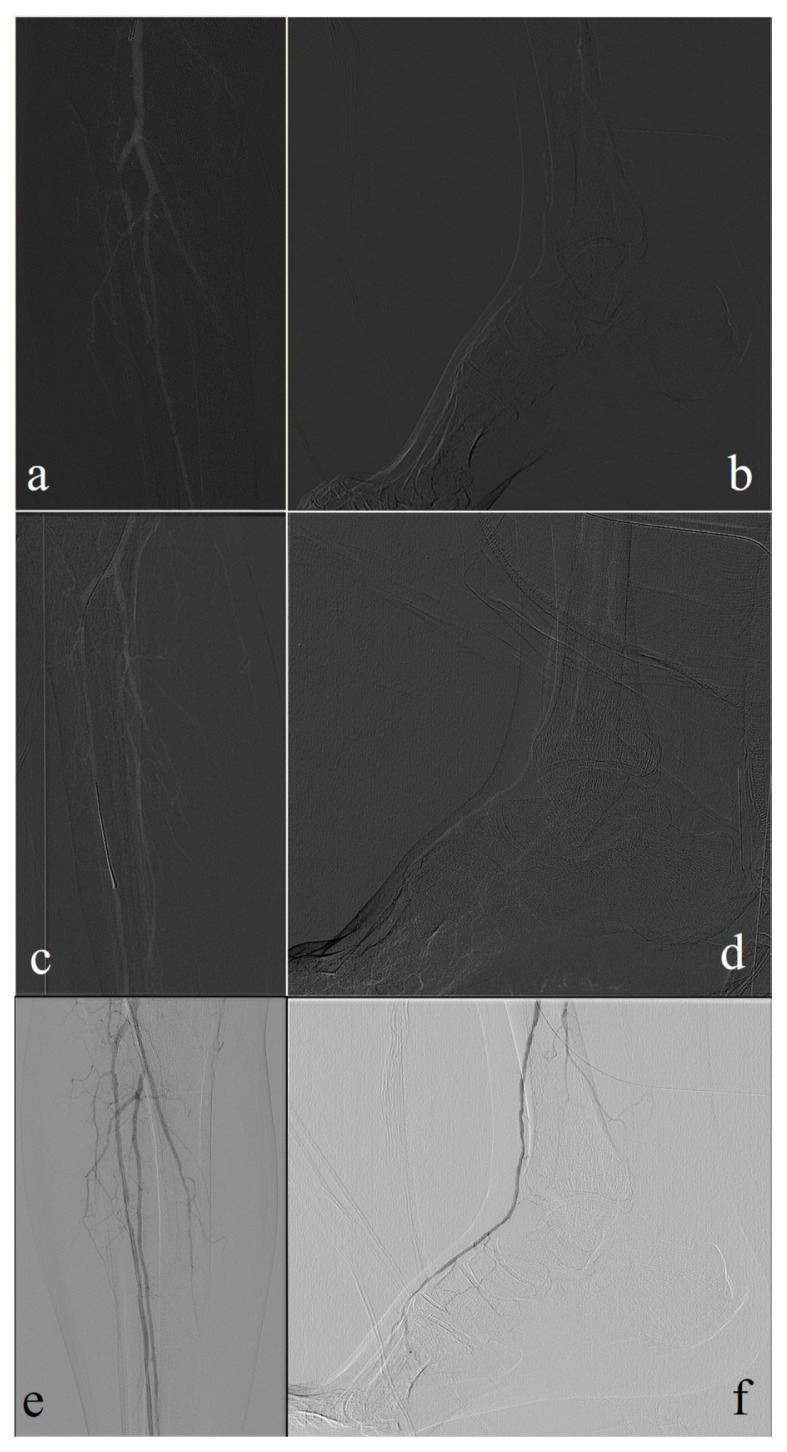 The role of carbon dioxide angiography in reducing contrast-induced nephropathy in diabetic foot patients undergoing endovascular treatment.