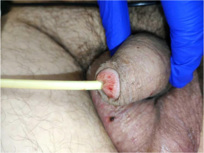 <i>Mycoplasma pneumoniae</i>-Induced Mucositis Sine Rash: <i>Case report in an adult patient</i>.
