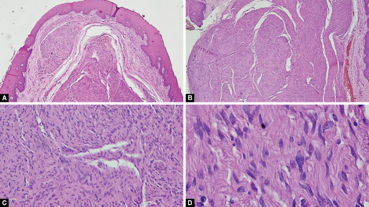 A Unique Finding in an Adolescent Male: A Case Report Navigating in Detail about Oral Neurofibroma.
