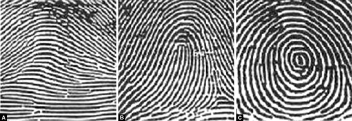Fingerprints and Its Correlation with Dental Caries, Molar Relation, and Cooperation of Children During Dental Treatment: A Cross-sectional Study.