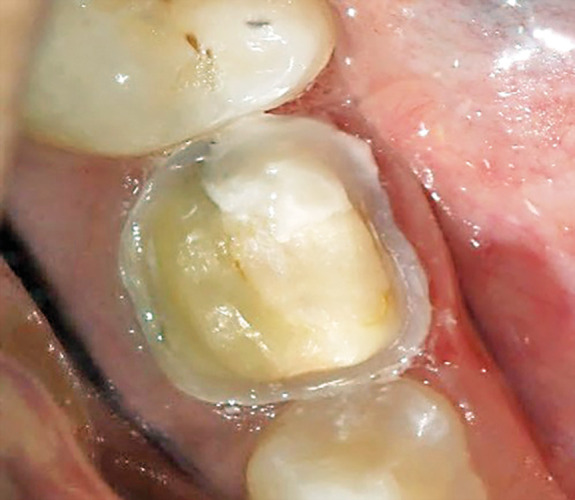 Three-dimensional-printed Photopolymer Resin Crowns vs Computer-aided Milled Polymethyl Methacrylate Crowns with Prefabricated Zirconia Crowns for Primary Molars: A Randomized Clinical Trial.
