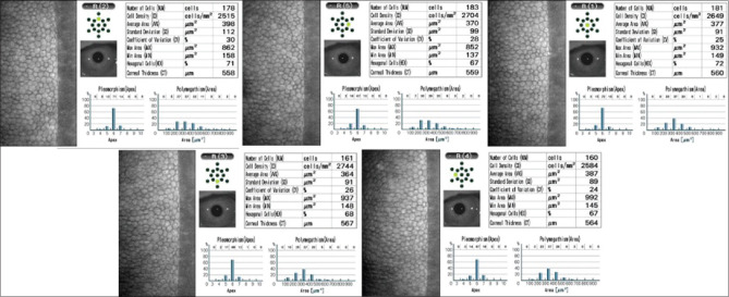 Excessive corneal endothelial single-cell loss following endothelial injuries.