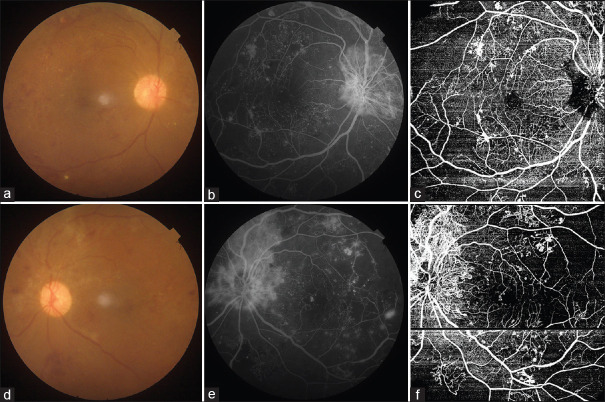 Comparison of swept source - Optical coherence tomography angiography with fundus fluorescein angiography for detection of lesions in diabetic retinopathy.