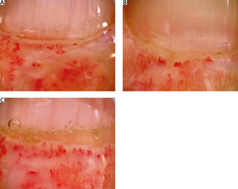 Chronic intestinal pseudo-obstruction in the course of systemic sclerosis successfully treated with intravenous immunoglobulins and rituximab.