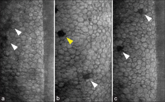 Excessive corneal endothelial single-cell loss following endothelial injuries.