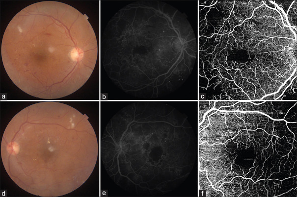 Comparison of swept source - Optical coherence tomography angiography with fundus fluorescein angiography for detection of lesions in diabetic retinopathy.