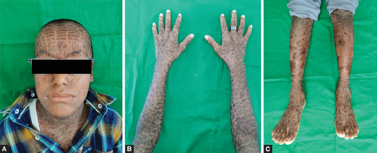 Oral Manifestations of Lamellar Ichthyosis: A Case Report of Two Siblings.