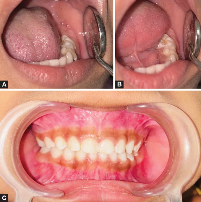 Congenital Fibrous Epulis in a 4-year-old Girl: A Rare Case Report.