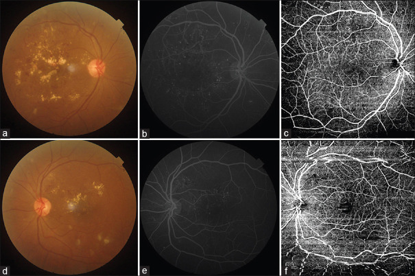 Comparison of swept source - Optical coherence tomography angiography with fundus fluorescein angiography for detection of lesions in diabetic retinopathy.