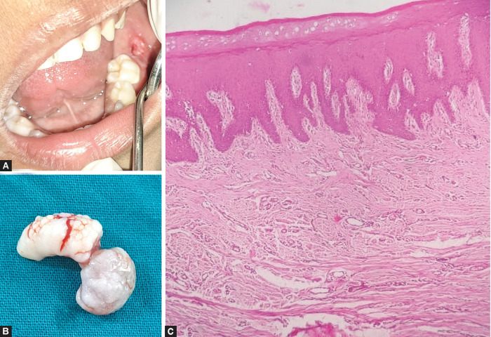 Congenital Fibrous Epulis in a 4-year-old Girl: A Rare Case Report.