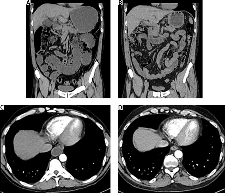 Chronic intestinal pseudo-obstruction in the course of systemic sclerosis successfully treated with intravenous immunoglobulins and rituximab.