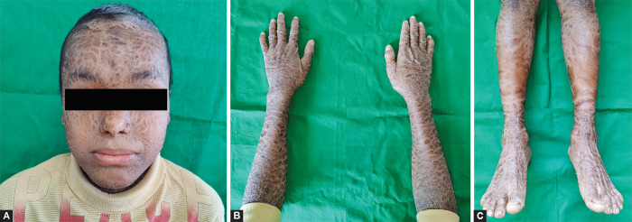 Oral Manifestations of Lamellar Ichthyosis: A Case Report of Two Siblings.