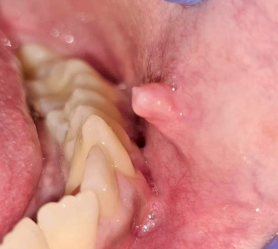 A Unique Finding in an Adolescent Male: A Case Report Navigating in Detail about Oral Neurofibroma.