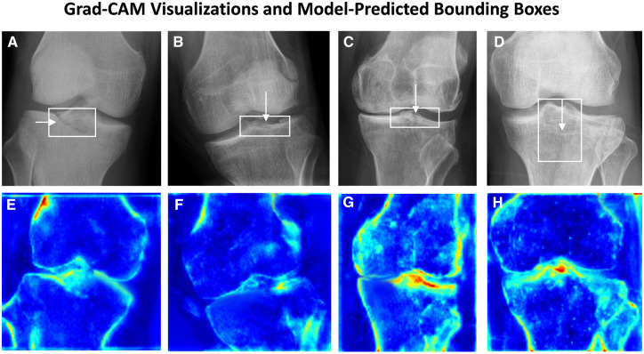 Deep learning diagnosis of adult tibial plateau fractures: multicenter study with external validation.