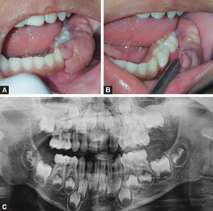 Congenital Fibrous Epulis in a 4-year-old Girl: A Rare Case Report.