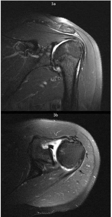 A Novel Treatment for Combined Adhesive Capsulitis and Glenohumeral Osteoarthritis - Case Study: RELIEF® Treatment.