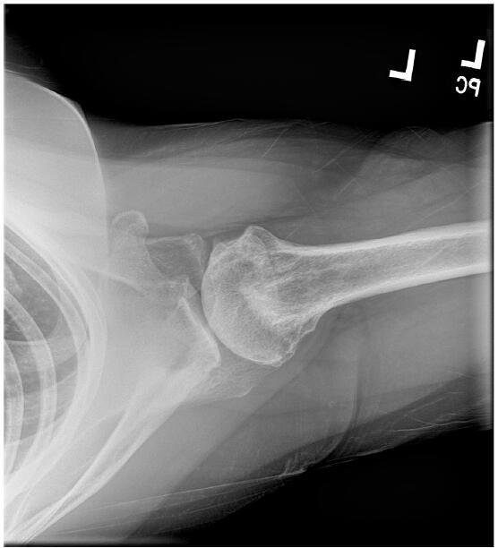 A Novel Treatment for Combined Adhesive Capsulitis and Glenohumeral Osteoarthritis - Case Study: RELIEF® Treatment.