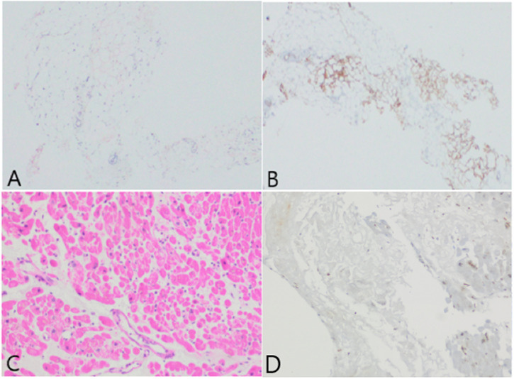 Letter to the Editor: A Rare Case of Upper Gastrointestinal Bleeding due to Amyloidosis.