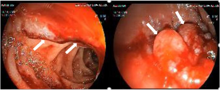 Letter to the Editor: A Rare Case of Upper Gastrointestinal Bleeding due to Amyloidosis.