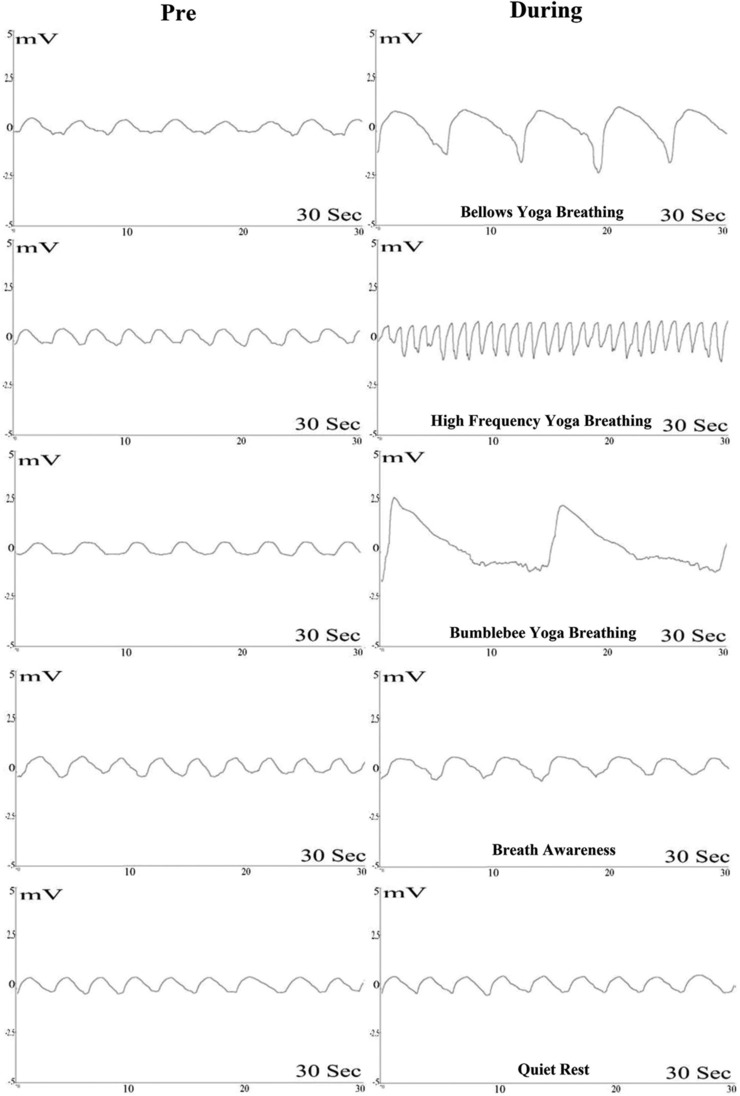 A Comparison of the Effects of Three Volitional Yoga Breathing Practices versus Two Nonvolitional Breathing Controls on Auditory-evoked Potentials.