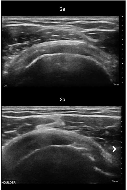 A Novel Treatment for Combined Adhesive Capsulitis and Glenohumeral Osteoarthritis - Case Study: RELIEF® Treatment.