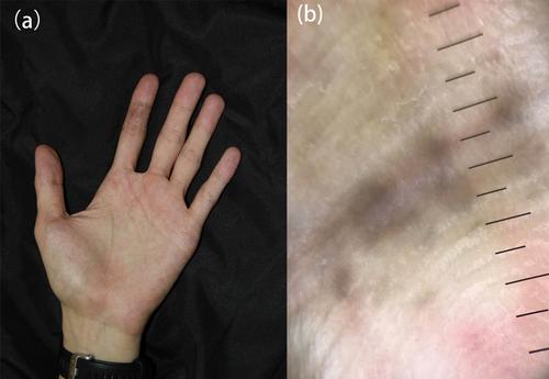 Dermoscopy Assisting Diagnosis of Dermal Melanocytosis Limited to the Hand
