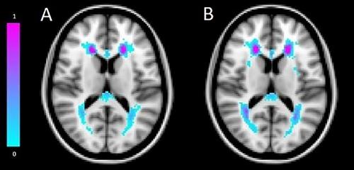 Cardiovascular Risk Factors Impact Brain Volume and White Matter Hyperintensities: A Multiethnic Cohort Study
