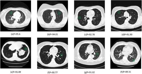 AMCF-Net: A Novel Adaptive Multi-Channel Fusion Network for Computer-Aided Diagnosis of Lung Nodules in Chest Computed Tomography