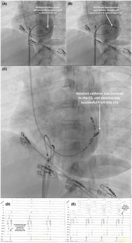 Catheter ablation of uncommon epicardial accessory pathway sites: A single-center case series