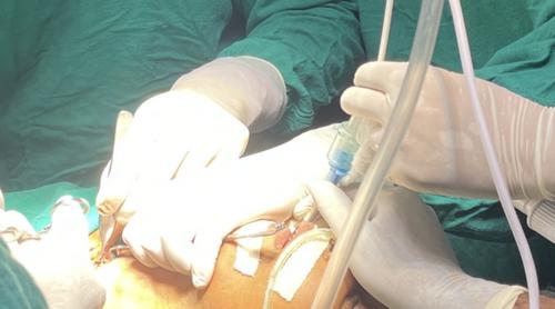 Managing Life-Threatening Tracheal Malignancy and Lung Metastases in a Young Woman: A Case of Aggressive Airway Intervention