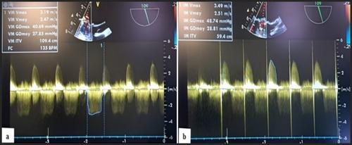 Massive Acute Thrombosis of a Mechanical Mitral Valve in a Young Patient on Acenocoumarin: A Case Report Comparing Surgical and Thrombolytic Approaches