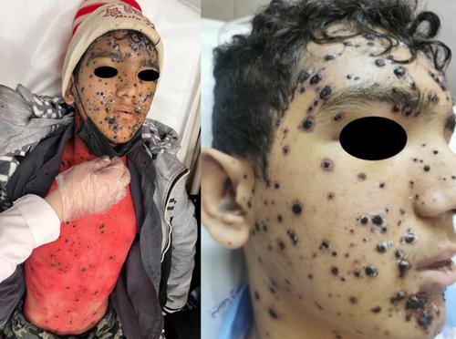 A Red Skin in the Setting of Chickenpox: A Rare Report of Eosin Toxicity