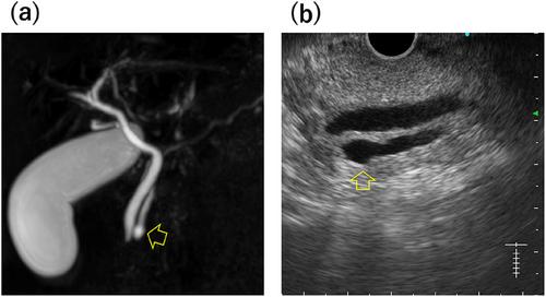 Wirsungocele as a Rare Cause of Recurrent Pancreatitis: Etiology and Therapeutic Insights