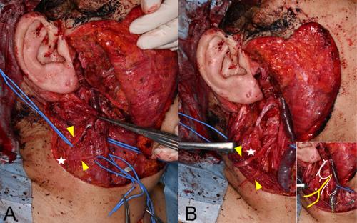 The Great Auricular Nerve as a Nerve Graft Donor: An Anatomical and Clinical Study of the Maximum Harvestable Length and Branches