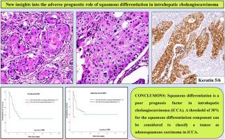 New insights into the adverse prognostic role of squamous differentiation in intrahepatic cholangiocarcinoma: A comprehensive analysis