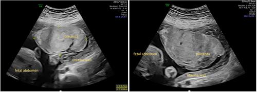 Placenta Pathologies in Two Patients With Glycogen Storage Disease Type Ia and Preeclampsia