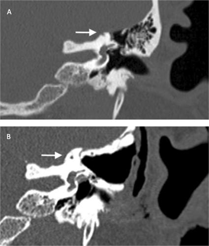 Superior Semicircular Canal Dehiscence Repair With Hydroxyapetite Cement via a Transmastoid Approach